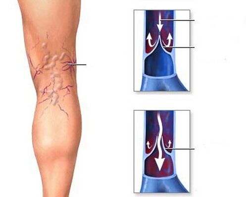 consecuencias das varices das pernas