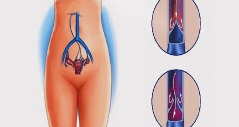 Anatomía dos órganos xenitais femininos e veas afectadas por varices na pelve